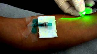 Intravenöse Laserblutbestrahlung mit dem Weberneedle® Endo Laser [upl. by Orvie]