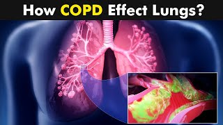 Chronic Obstructive Pulmonary Disease COPD  Symptoms Causes And Treatment UrduHindi [upl. by Hayse610]