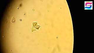 CaOxalate crystals in urine microscopy at 40XCrystals in urine [upl. by Eedolem]