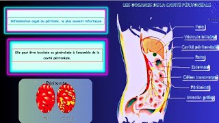 La péritonite aigue [upl. by Esilrahc]