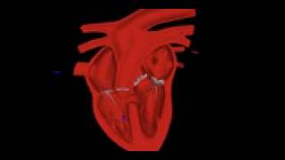 Auscultation communication intraventriculaire [upl. by Kimberley]