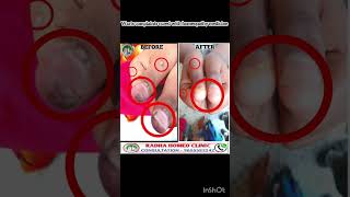 wart treatment in tamil  warts removal in tamil  maru poga tips in tamil  dr balajimuthu [upl. by Inverson]