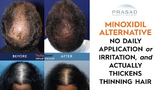 MINOXIDIL Top 6 Brands In India For Hair Regrowth  Benefits amp How it Works amp Side Effects [upl. by Oinegue]