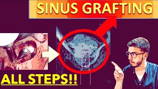 Sinus Lift All Steps for Beginners Easy Dentistry Maxillary sinus floor augmentation bone graft [upl. by Ambrosane]