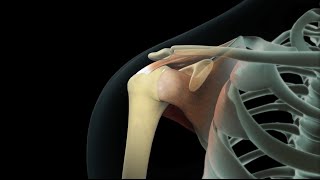 Rotator Cuff Shoulder Surgery [upl. by Assenyl336]