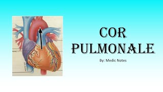 Cardiology Cor Pulmonale  definition causes signs amp symptoms investigation treatment [upl. by Ciredor117]