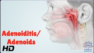 AdenoiditisAdenoids Everything You Need To Know [upl. by Llekram]