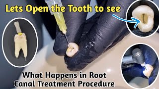 Root Canal Treatment Demonstration  Root Canal Procedure  RCT  Endodontics [upl. by Kizzie77]