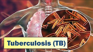 Tuberculosis TB I Causes Symptoms Prevention amp Treatment [upl. by Nylhtak257]