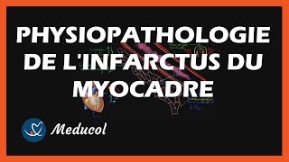 Infarctus du myocarde  symptômes et physiopathologie de la crise cardiaque [upl. by Annaiviv]