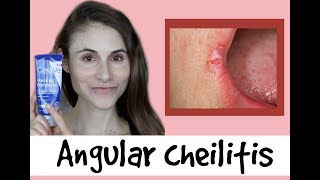 Angular cheilitis causes amp treatments a QampA with dermatologist Dr Dray [upl. by Clower993]