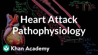 Heart attack myocardial infarction pathophysiology  NCLEXRN  Khan Academy [upl. by Teerpnam177]