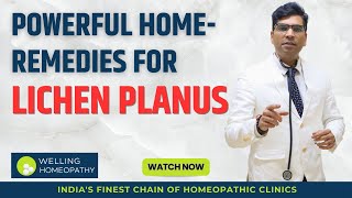 Powerful Home Remedies For Lichen Planus [upl. by Enyawud]