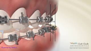 Elastics  Crossbite  Orthodontic Treatment [upl. by Arba]