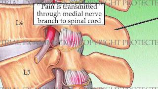 Lumbar Diagnostic Facet Injection [upl. by Mij]