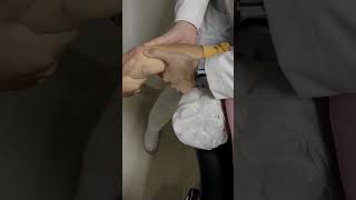 FRACTURA LUXACION DE CODO ELBOW FRACTURE DISLOCATION [upl. by Grail]