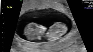 11 Weeks 2 Days Fetal Ultrasound  Baby Jumps [upl. by Wurtz492]