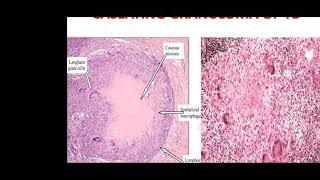 INFLAMMATION Part 8 GRANULOMA and granulomatous Inflammation [upl. by Bose58]