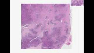 Histopathology Lymph nodeNodular sclerosis Hodgkin lymphom [upl. by Cissej]