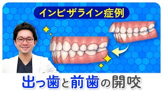 【インビザライン経過症例５】マウスピース矯正 出っ歯と開咬（非抜歯） 矯正専門歯科医師が解説 [upl. by Bethezel]