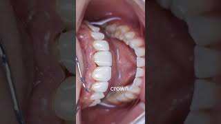 Veneers vs Crown  Front Teeth  Aesthetic  Dentistry [upl. by Reyam]