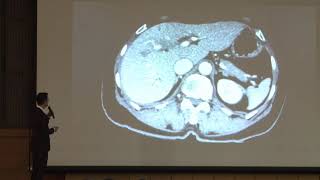 Surgical anatomy of perihilar cholangiocarcinoma [upl. by Anchie100]