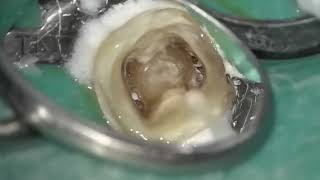 1min Create of Coronal Matrix Subgingival [upl. by Odeen]