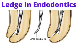 Ledge in Endodontics Root Canal What Causes Prevention Removal Bypass and Management [upl. by Leticia]