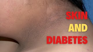 Know if you have diabetes by recognizing these signs on your skin [upl. by Brewster101]