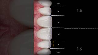 Behind every confident smile lies a meticulous process shorts dentaltechnology smiledesign [upl. by Eiramrefinnej427]