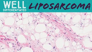 Well differentiated liposarcoma aka atypical lipomatous tumor pathology sarcoma soft tissue tumor [upl. by Ocir]