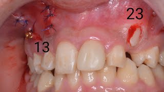 VISTA flap for impacted upper right canine using closed traction technique by Dr Ebrahim Elhadad [upl. by York]