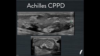 Achilles CPPD [upl. by Donnenfeld]