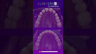 Clear Aligners Journey  Before And After  Aligners4u Hyderabad  Invisible Aligners  Braces [upl. by Blondie]