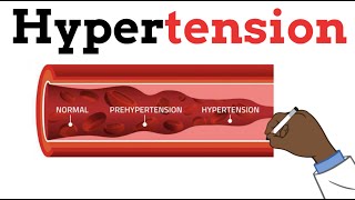 Hypertension  Best for beginners Risk factors Pathophysiology Causes Diagnosis Medications [upl. by Orel]