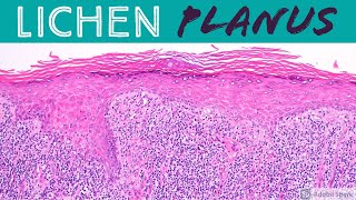 Lichen Planus amp Hypertrophic Lichen Planus Inflammatory Dermpath 101 for Dermatology amp Pathology [upl. by Notsniw803]