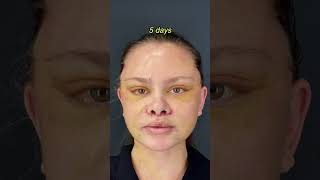 face lift  before after  women secrets [upl. by Vaclav]