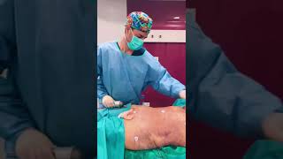 Dr Levy • Liposuctie lipoaspiratie ABDOMINALA Vibrasat  Power Assisted Liposuction amp VASER PRO [upl. by Ahtnicaj]