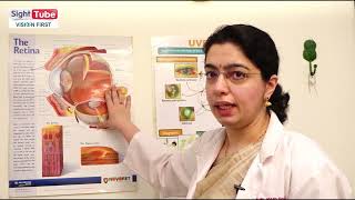 Uveitis and its treatment by Dr Abhilasha Baharani Neoretina Eyecare Institute Hyderabad [upl. by Relyat]