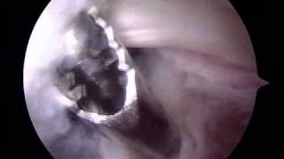 Arthroscopic Removal of Bakers Cyst  ORV  Raymond Whitehead MD [upl. by Adham293]