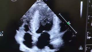 NON OBSTRUCTIVE CARDIOMYOPATHY [upl. by Obala]