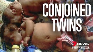 The heartwarming story of Trishna amp Krishna Conjoined twins separated [upl. by Etz]