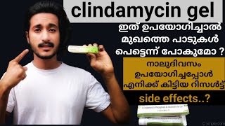 clindamycin gel malayalam  acne remove clindamycin gel  side effects  4 days  remove pimple [upl. by Anauq564]