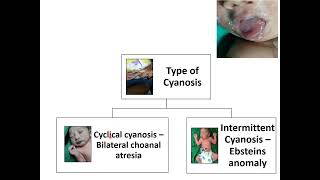 Cyanosis  Pediatrics [upl. by Sandye]