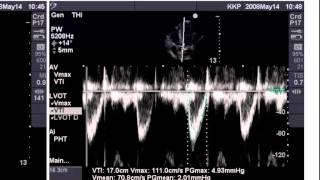 Point of Care Echo Stroke Volume Determination [upl. by Eam]