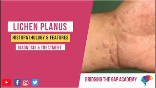 What is Lichen Planus Histopathology amp Features Diagnosis amp Treatment [upl. by Remlap]