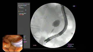 ERCP  EST with SEMS placement for mid CBD stricture from advance pancreatic cancer [upl. by Mabel329]