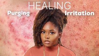 PURGING OR IRRITATION  Esthetician Explains How to Identify and Treat Both Conditions [upl. by Broek803]