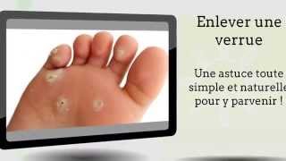 Enlever une verrue  Mon astuce simple et efficace pour y arriver [upl. by Switzer]