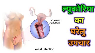 ल्यूकोरिया का घरेलु उपचार कैसे करे  Leukorrhea treatment in hindi  safed pani ka desi gharelu ilaj [upl. by Vil621]